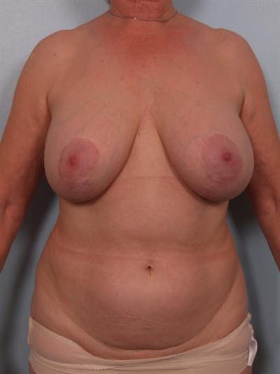Complex Breast Revision Before & After Gallery - Patient 1310729 - Image 1
