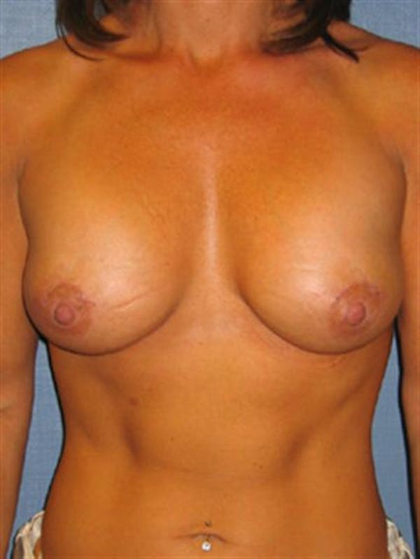 Breast Lift Before & After Gallery - Patient 1310730 - Image 2
