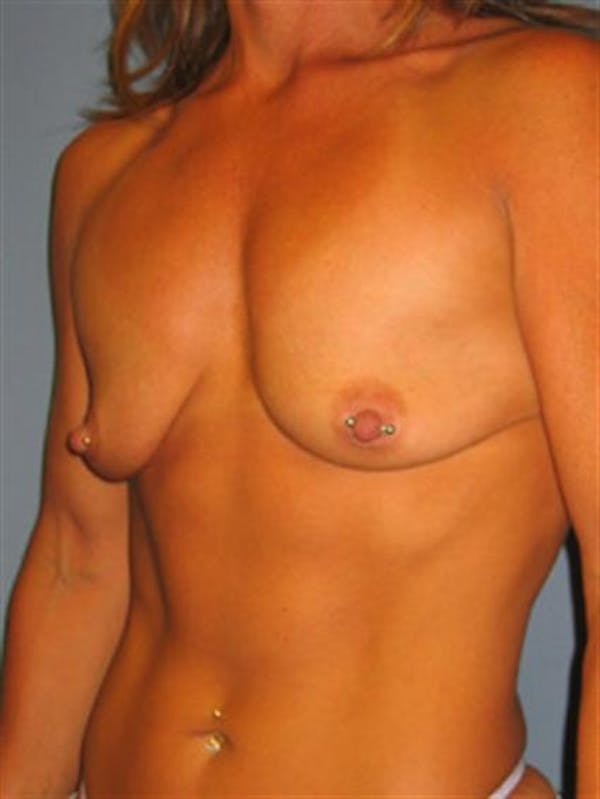 Breast Lift Gallery - Patient 1310730 - Image 3