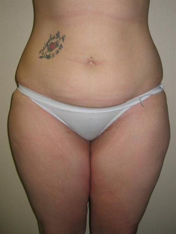 Power Assisted Liposuction Gallery - Patient 1310728 - Image 7