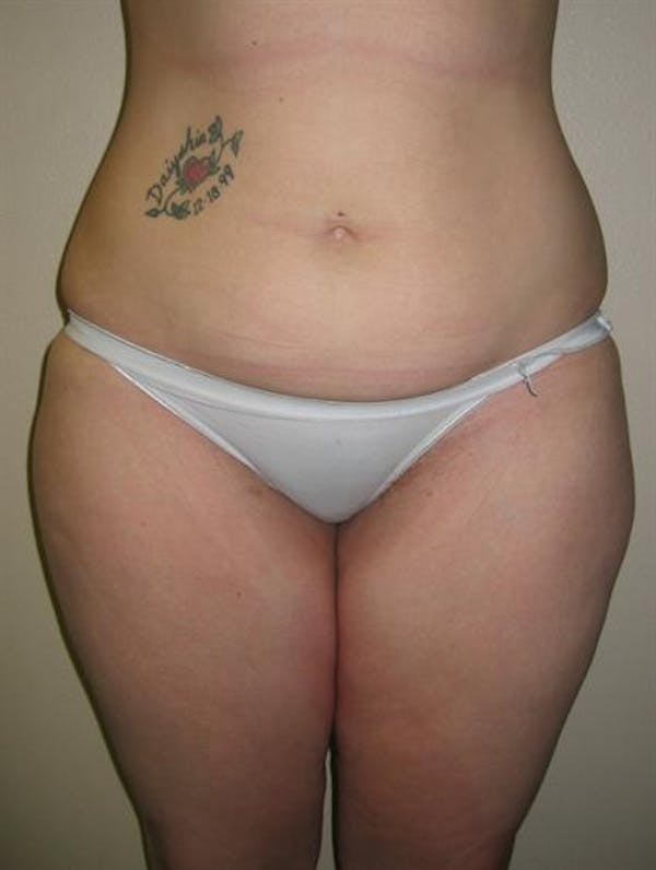 Power Assisted Liposuction Before & After Gallery - Patient 1310728 - Image 7