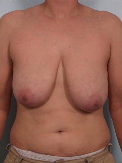 Breast Reduction Gallery - Patient 1310731 - Image 1