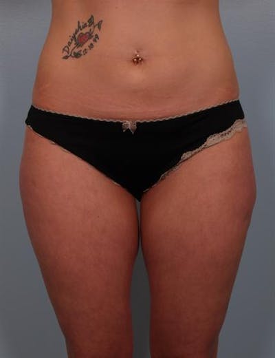 Power Assisted Liposuction Before & After Gallery - Patient 1310728 - Image 8