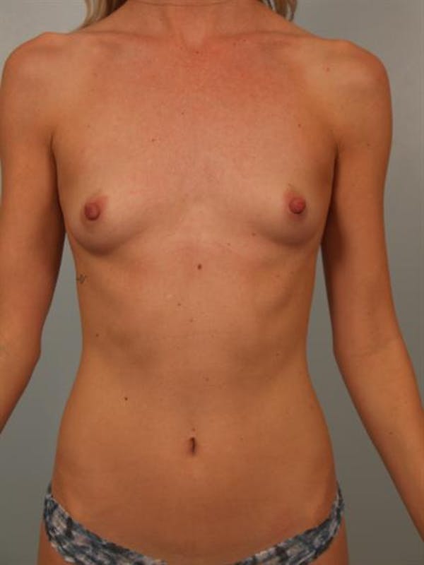 Breast Augmentation Before & After Gallery - Patient 1310733 - Image 1