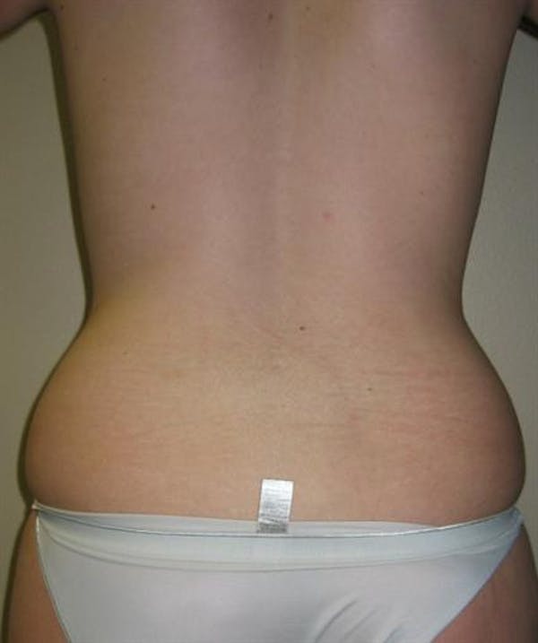Power Assisted Liposuction Before & After Gallery - Patient 1310728 - Image 9