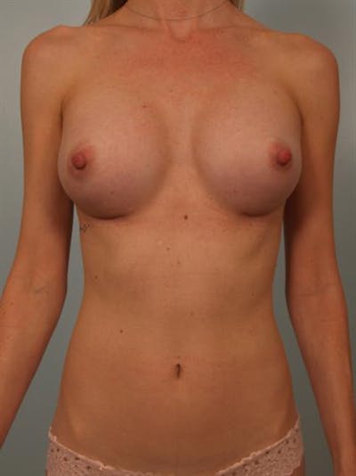 Breast Augmentation Before & After Gallery - Patient 1310733 - Image 2