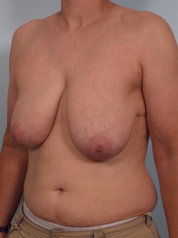 Breast Reduction Before & After Gallery - Patient 1310731 - Image 5