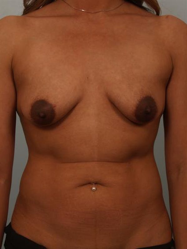 Breast Lift Gallery - Patient 1310736 - Image 1