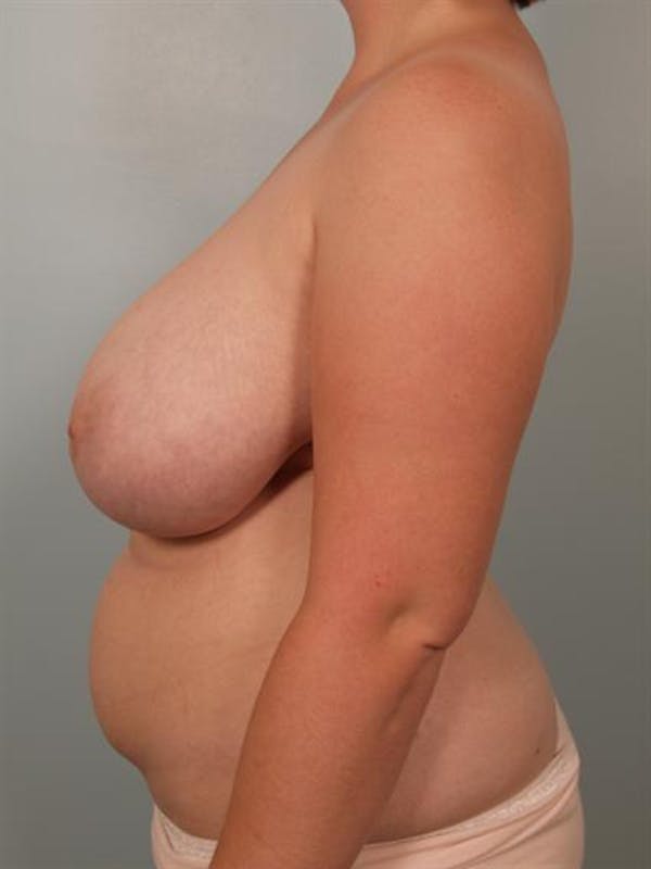 Breast Reduction Before & After Gallery - Patient 1310737 - Image 3