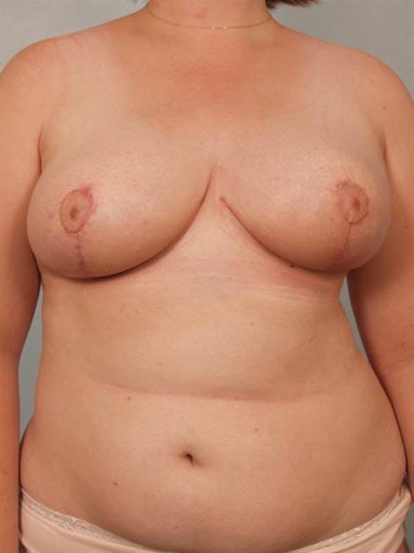 Breast Reduction Gallery - Patient 1310737 - Image 2