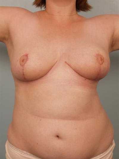 Breast Reduction Before & After Gallery - Patient 1310737 - Image 6