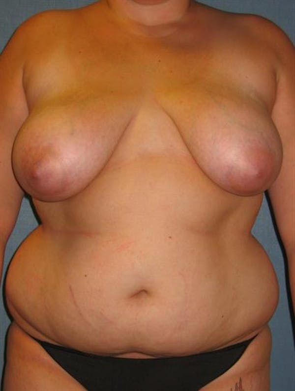 Power Assisted Liposuction Gallery - Patient 1310740 - Image 1
