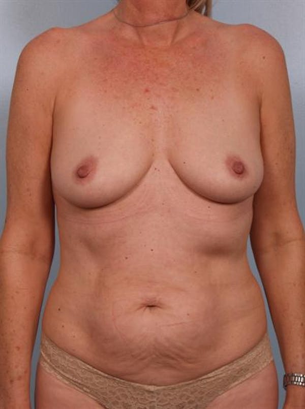 Mommy Makeover Before & After Gallery - Patient 1310738 - Image 1