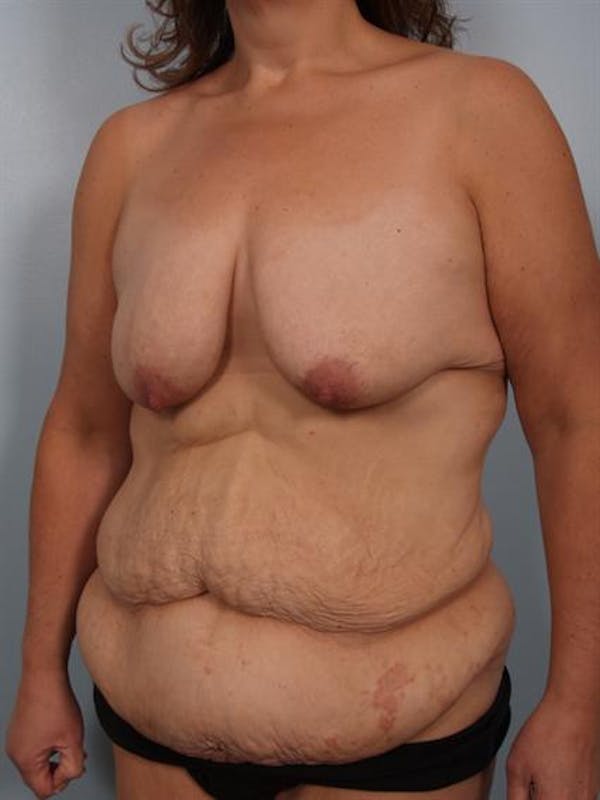 Breast Lift Before & After Gallery - Patient 1310742 - Image 3