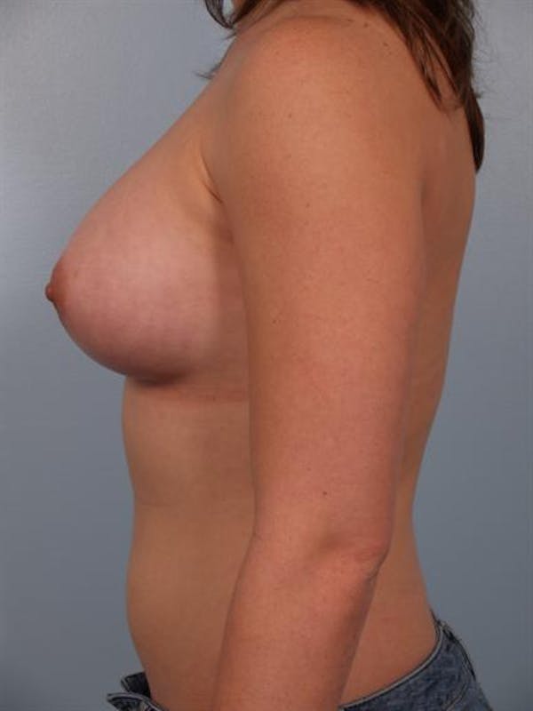 Breast Augmentation Gallery - Patient 1310741 - Image 4