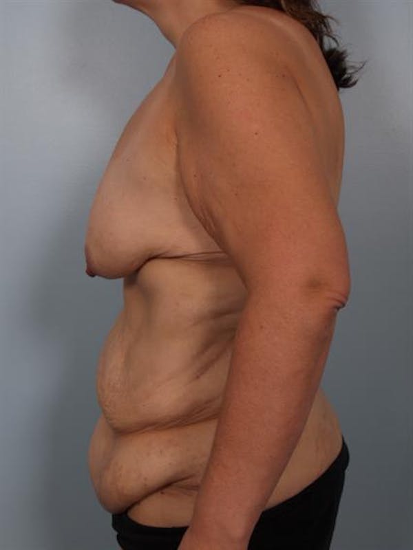 Breast Lift Before & After Gallery - Patient 1310742 - Image 5