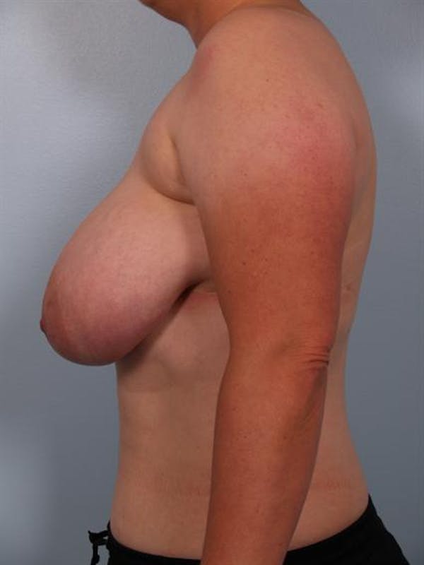 Breast Reduction Before & After Gallery - Patient 1310745 - Image 3