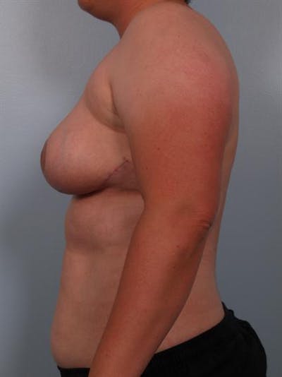 Breast Reduction Before & After Gallery - Patient 1310745 - Image 4