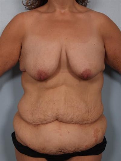 Breast Lift Before & After Gallery - Patient 1310742 - Image 1