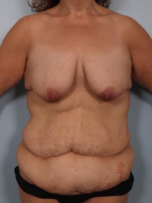 Breast Lift Before & After Gallery - Patient 1310742 - Image 1