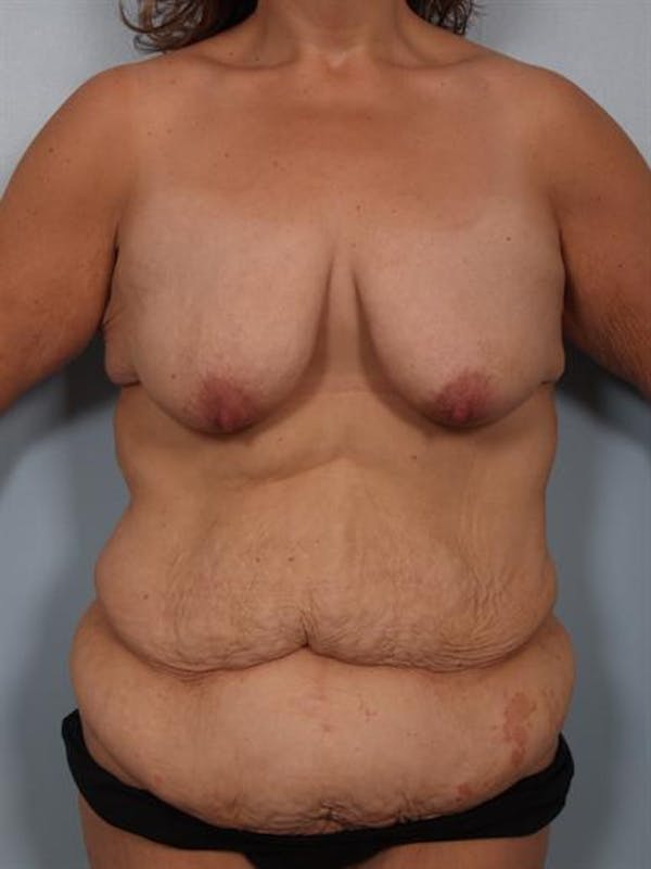 Breast Lift Gallery - Patient 1310742 - Image 1