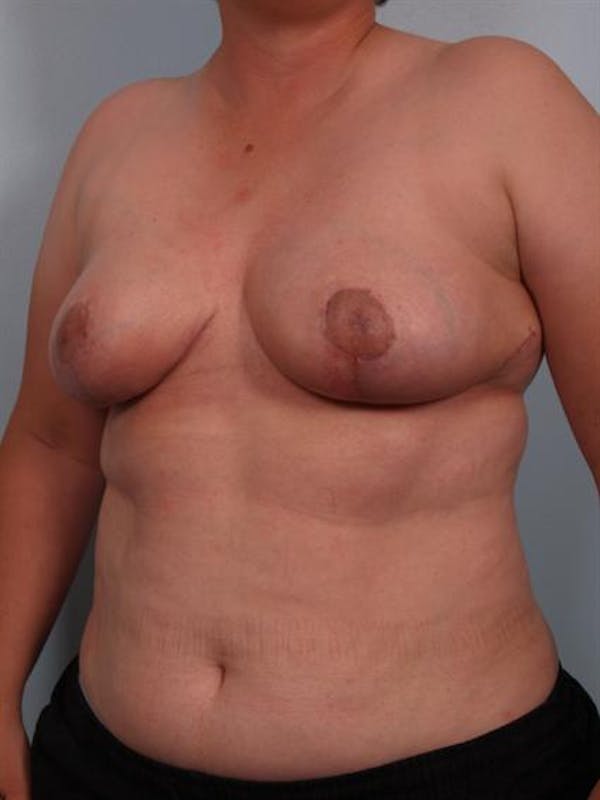 Breast Reduction Gallery - Patient 1310745 - Image 6