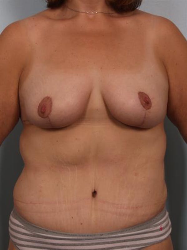 Breast Lift Before & After Gallery - Patient 1310742 - Image 2