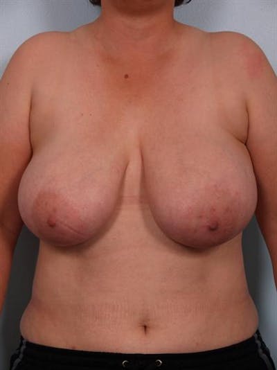 Breast Reduction Before & After Gallery - Patient 1310745 - Image 1
