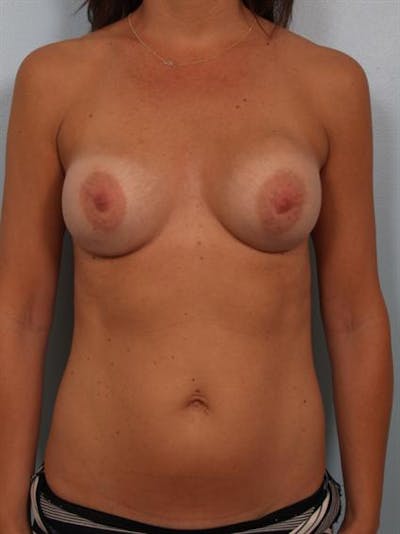 Complex Breast Revision Before & After Gallery - Patient 1310746 - Image 1