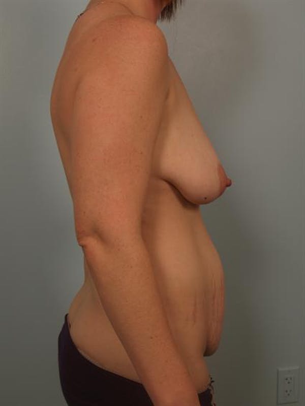 Mommy Makeover Before & After Gallery - Patient 1310744 - Image 5