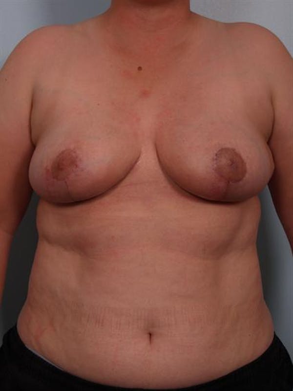 Breast Reduction Before & After Gallery - Patient 1310745 - Image 2