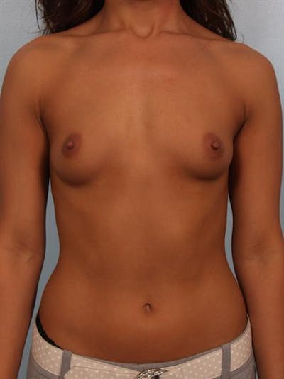 Breast Augmentation Before & After Gallery - Patient 1310752 - Image 1