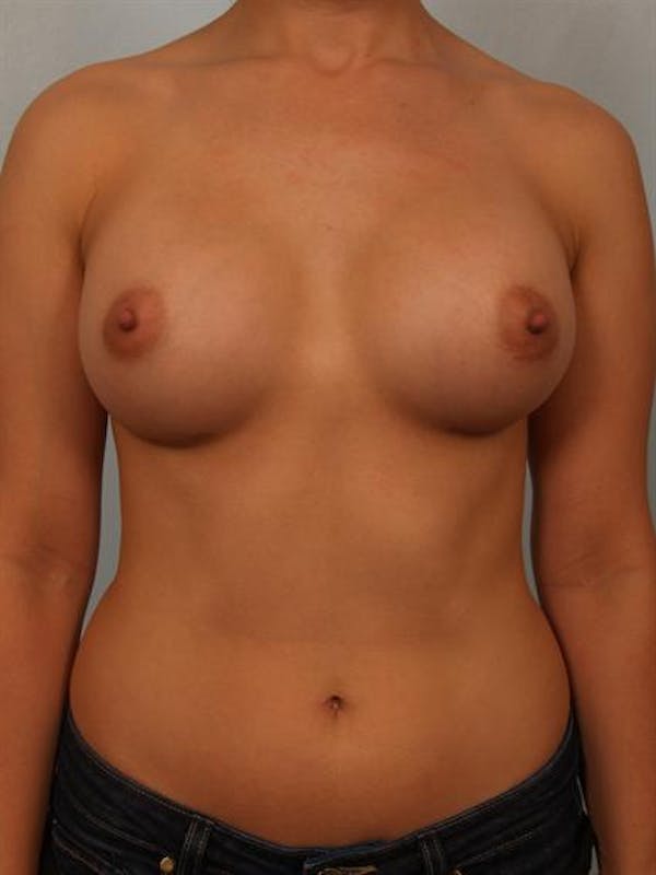 Breast Augmentation Gallery - Patient 1310752 - Image 2