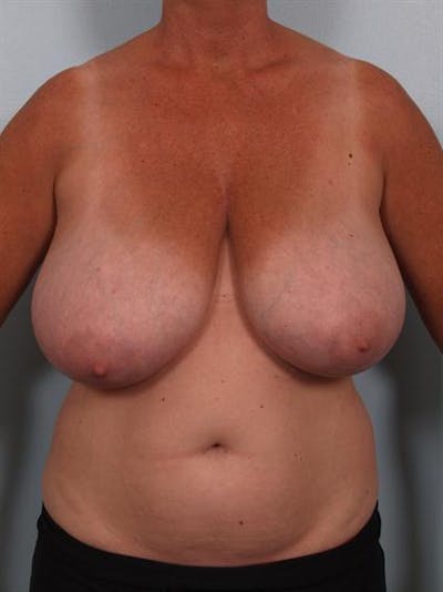 Breast Reduction Before & After Gallery - Patient 1310753 - Image 1
