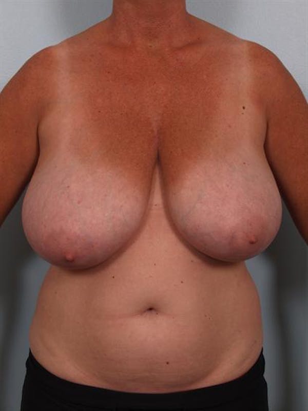 Breast Reduction Before & After Gallery - Patient 1310753 - Image 1