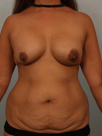 Complex Breast Revision Before & After Gallery - Patient 1310754 - Image 1