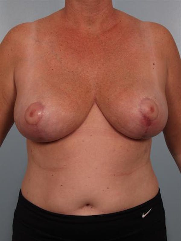Breast Reduction Before & After Gallery - Patient 1310753 - Image 2