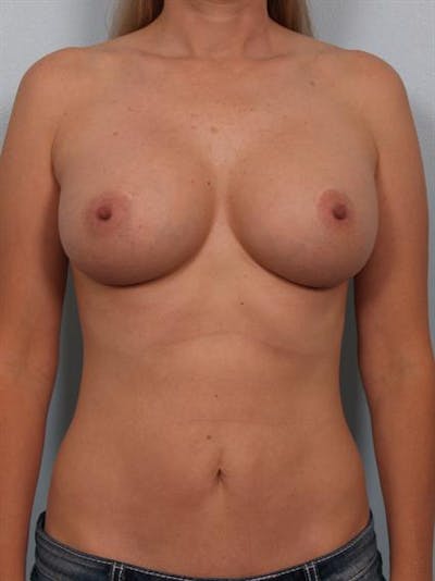Mommy Makeover Before & After Gallery - Patient 1310750 - Image 2