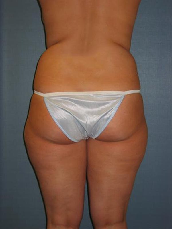 Power Assisted Liposuction Before & After Gallery - Patient 1310756 - Image 1