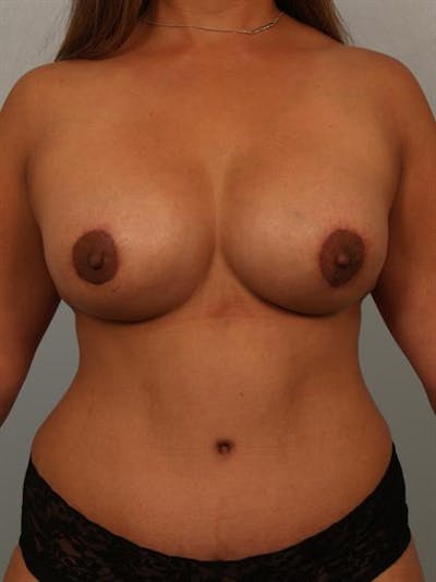 Complex Breast Revision Before & After Gallery - Patient 1310754 - Image 2