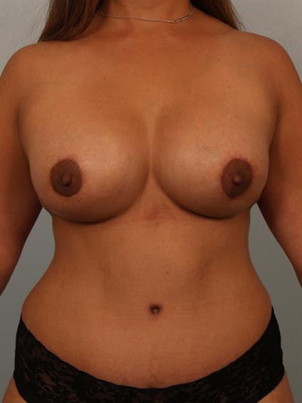 Complex Breast Revision Before & After Gallery - Patient 1310754 - Image 2