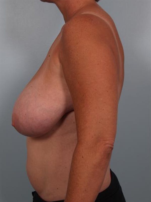 Breast Reduction Before & After Gallery - Patient 1310753 - Image 3