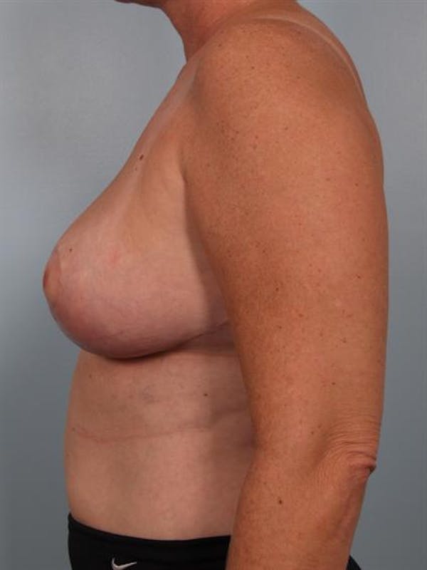 Breast Reduction Before & After Gallery - Patient 1310753 - Image 4