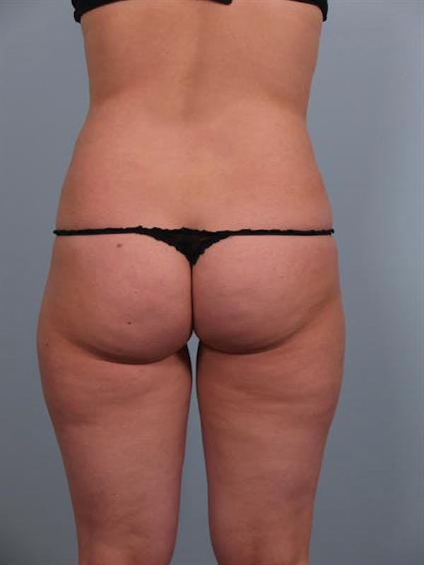 Power Assisted Liposuction Before & After Gallery - Patient 1310756 - Image 2