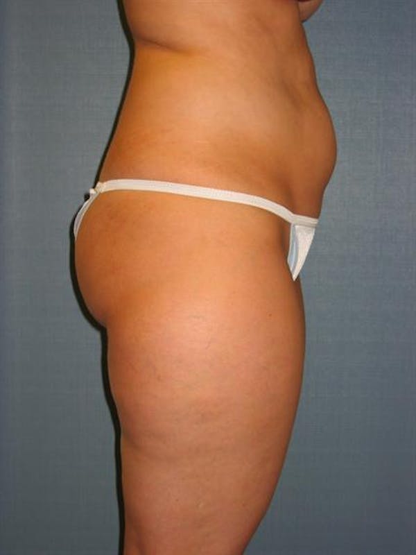 Power Assisted Liposuction Gallery - Patient 1310756 - Image 3