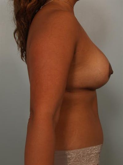 Complex Breast Revision Before & After Gallery - Patient 1310754 - Image 4