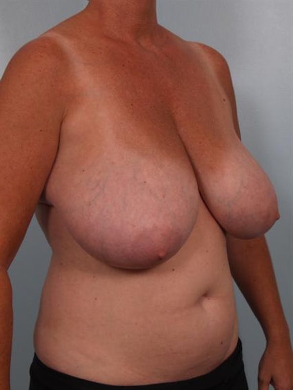 Breast Reduction Before & After Gallery - Patient 1310753 - Image 5
