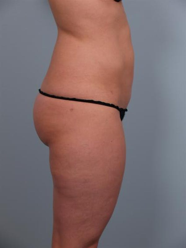 Power Assisted Liposuction Before & After Gallery - Patient 1310756 - Image 4