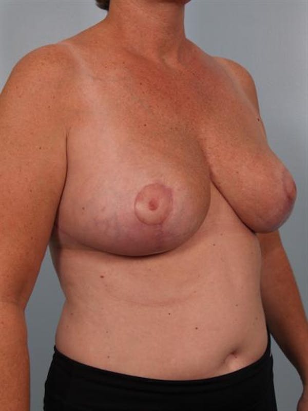 Breast Reduction Before & After Gallery - Patient 1310753 - Image 6