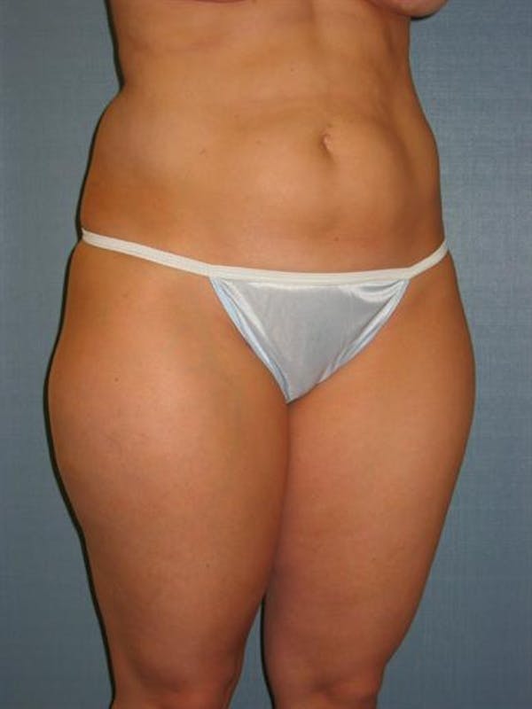 Power Assisted Liposuction Gallery - Patient 1310756 - Image 5